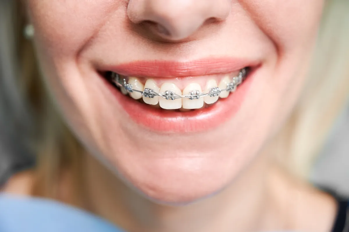 Sorriso com aparelho ortodôntico fixo convencional