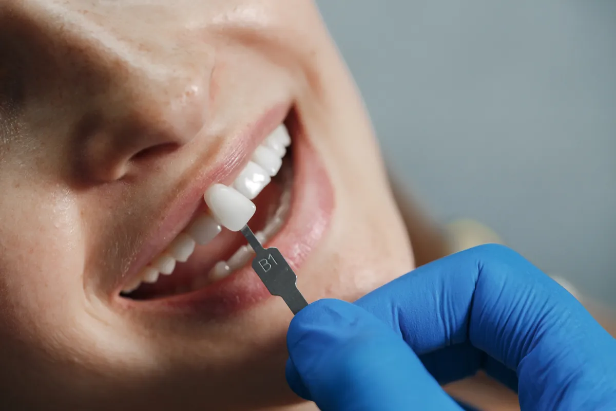 Seleção de cor para lentes de contato dental em resina