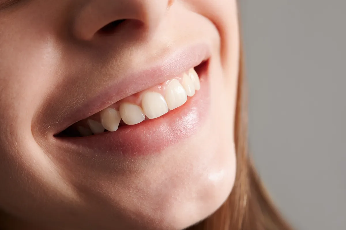 Sorriso natural após restauração em resina na cor do dente